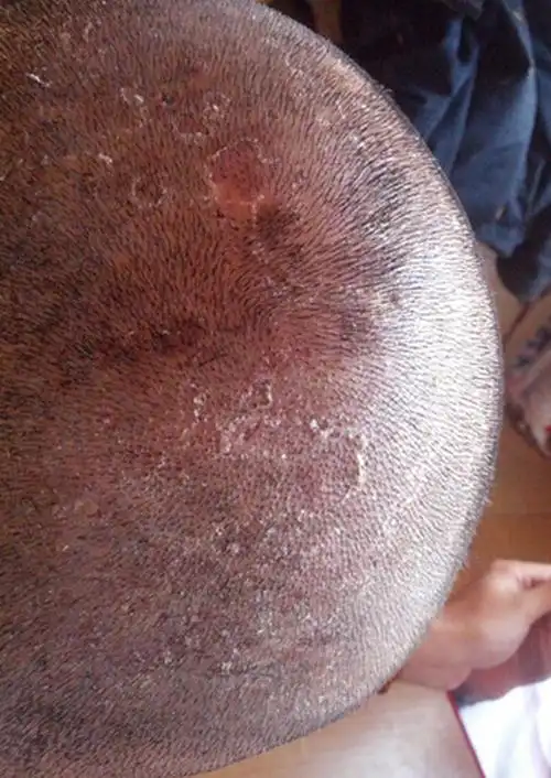 阴茎长毛囊炎的症状图片