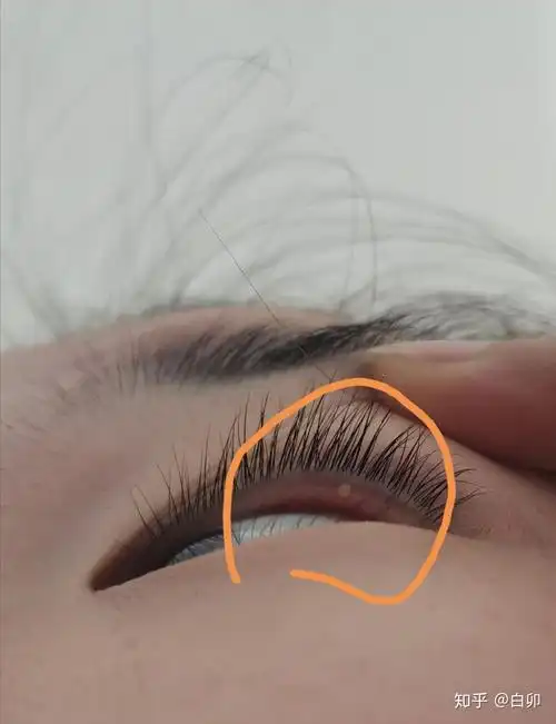 眼睛睫毛根部长疙瘩不痛不痒用手可以扣掉类似痘痘的这是什么
