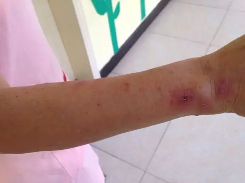 真恐怖啊,我竟被该死的红蚂蚁咬成这个样子了!