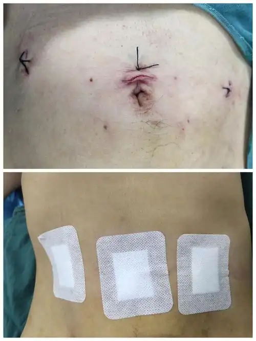 我院完成一例腹腔镜下右侧腹股沟疝修补术