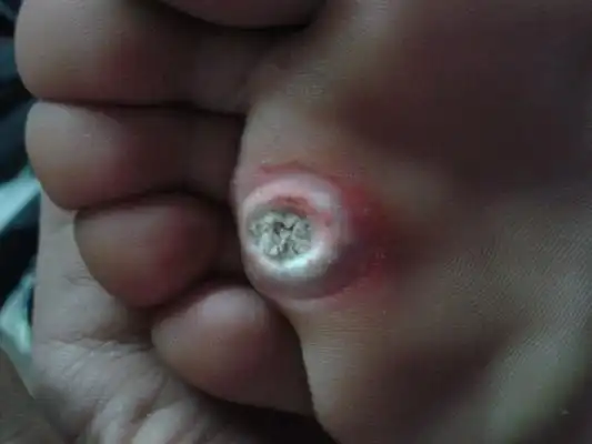 脚鸡眼图片 (3)_有来医生