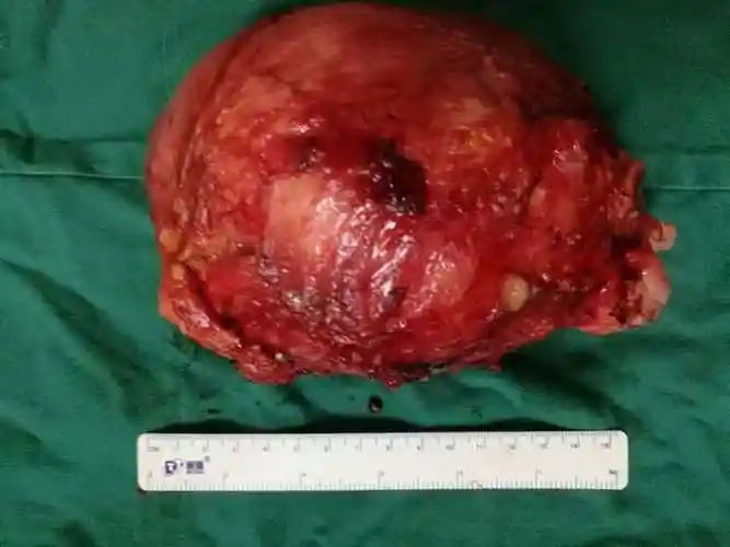 一例巨大膀胱癌的临床诊治 - 好大夫在线