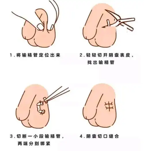 男性结扎会影响夫妻生活别再把避孕当成女人一个人的事了