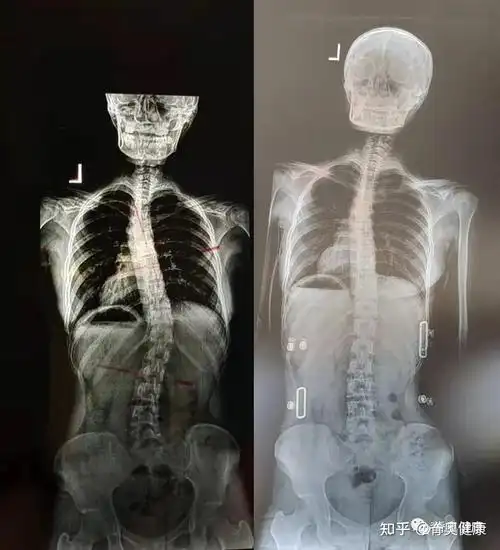 脊奥健康|少女脊柱侧弯案例展示--脊柱侧弯 扁平足 - 知乎