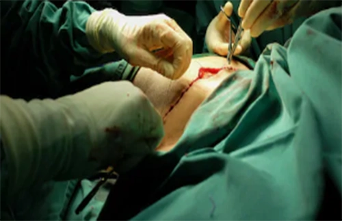 乳腺癌患者切除乳房后的选择