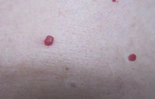 不管男女,身上长这种小红点当心是癌症的征兆