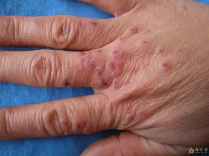 典型病例分享:寒冷性多形红斑.