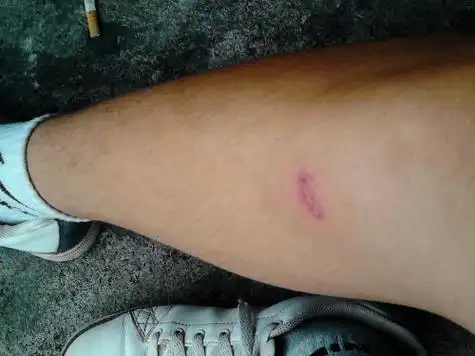 蟑螂咬了图片是什么样子