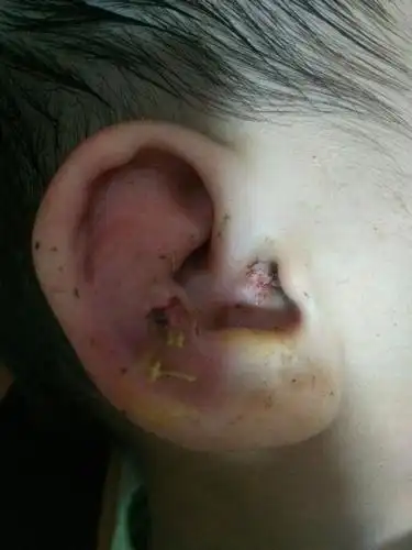 小孩耳郭长了个大脓包耳朵红肿要怎么处理