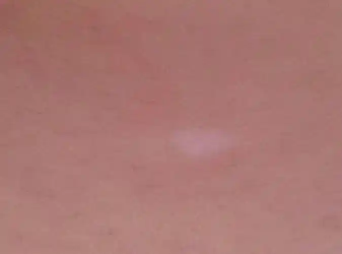 问:肚子上长了一个白斑有三四年了也不见好请问是白癜风吗