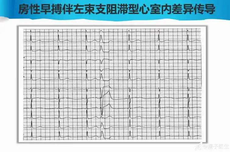 【医路拾遗】房性早搏伴心室内差异性传导的心电图解析