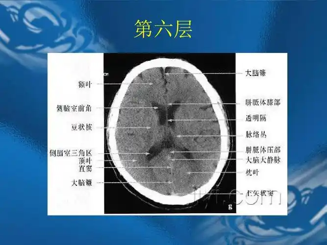 ct片的阅读技巧(头部)