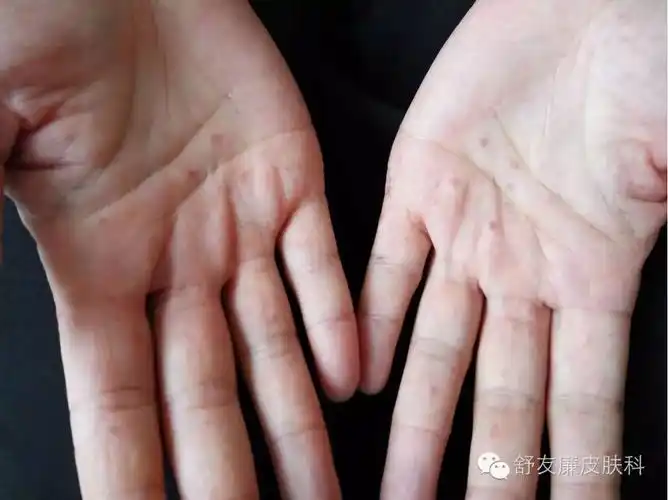 手足口病皮损的照片 - 好大夫在线