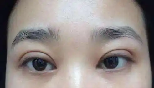 双眼皮太宽会比较假,看起来不自然.