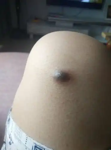 20  问医生 浏览官网  展开全部 你好,根据你的图片,考虑皮脂腺囊肿