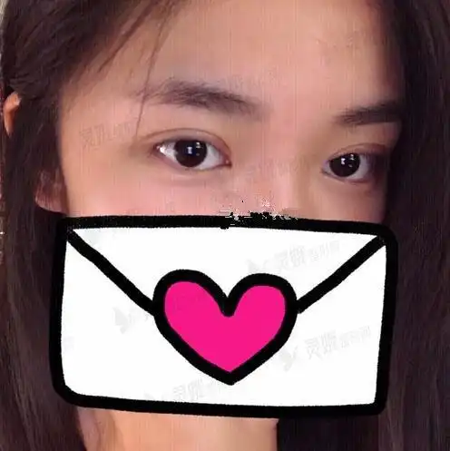 真人做鹿眼双眼皮后一周