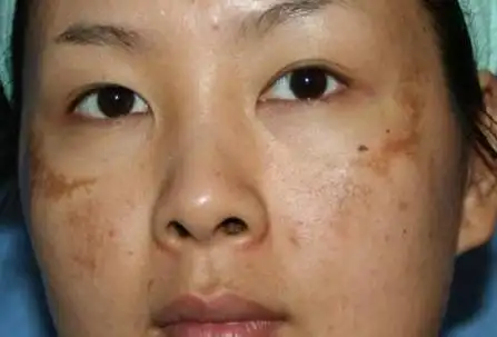 美丽的杀手"蝴蝶斑"_黑色素