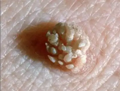 尖锐湿疣有哪些症状表现