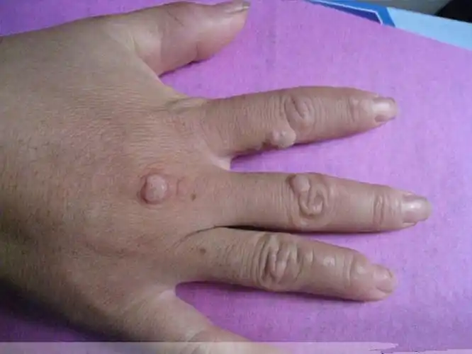 手上起跖疣图片