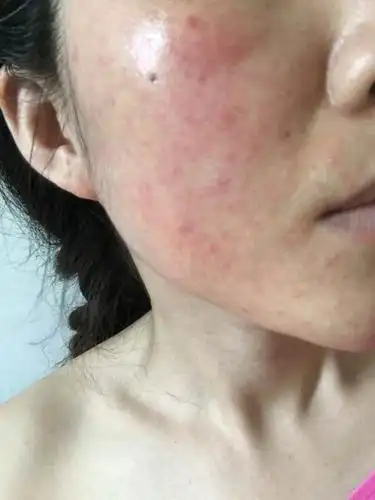 98激素脸的症状肌肤就会出现红,痒,干燥,脱皮,发痘痘严重的大面积发