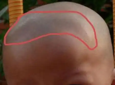 顺产分娩,经过产道挤压,新生宝宝的囟门会提早闭合吗?_婴儿