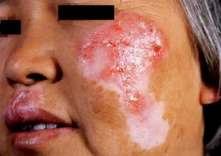 中年男子脸部红斑狼疮症状图片_有来医生