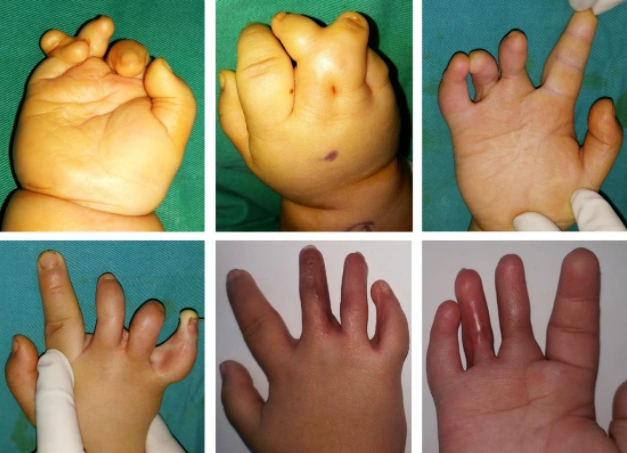 会相对更高些,很可能在做完手术一两年后,孩子的手指根部又爬起来了