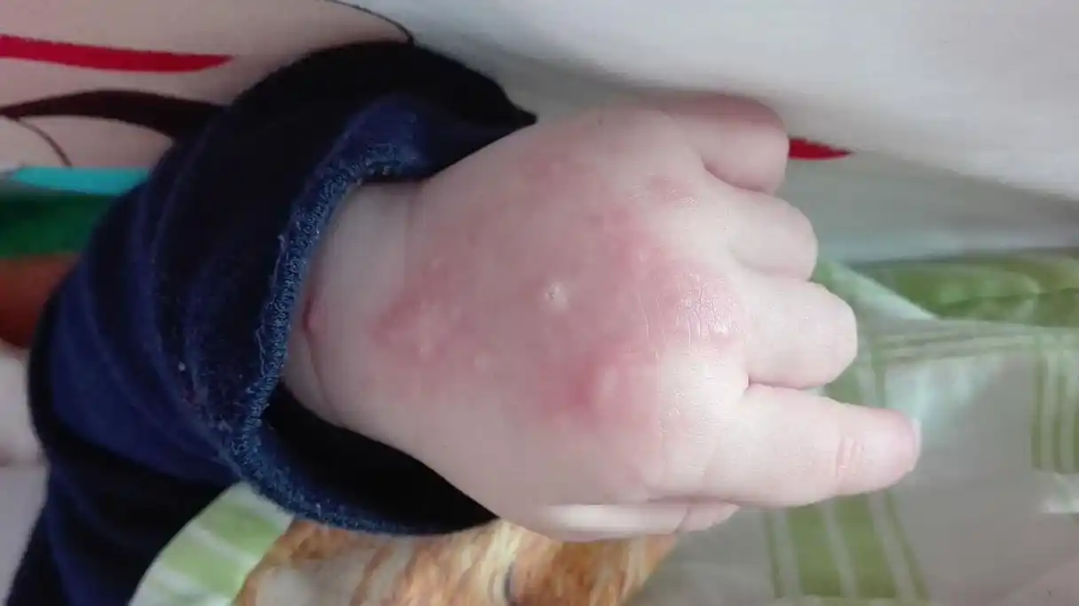 宝宝快8个月了,前两天被蚊子咬了一下,居然变成这个样子了,好像还