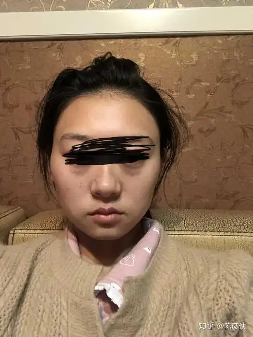 长期单侧咀嚼,导致一边脸大一边脸小,怎么恢复?