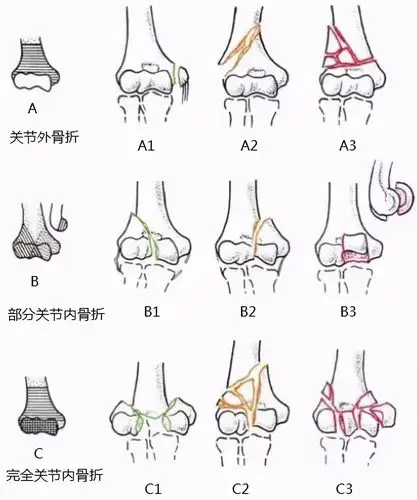 三,肱骨远端骨折的治疗肱骨远端治疗原则为关节的解剖复位,坚强的内