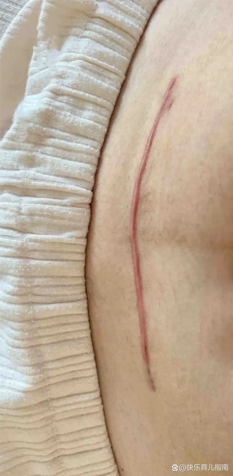 剖腹产六个月的刀口