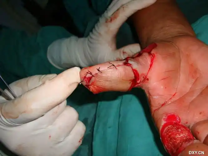 伤,皮瓣修复 xdw9 09-22 16:47          关注      患者因右手拇指