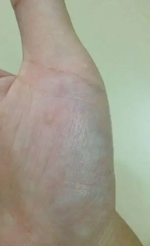 手掌上长有半透明微黄色的疙瘩,但是里面没水硬硬的,原来是几个后来又