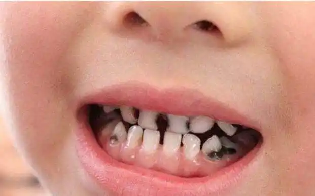 小孩牙齿蛀牙发黑,要怎么处理?