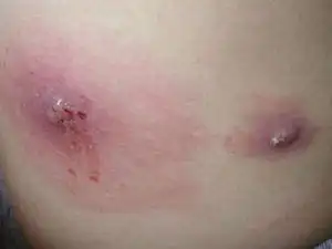 > 查看版本 肤蝇 - 基本内容 人肤蝇的幼虫———蛆.