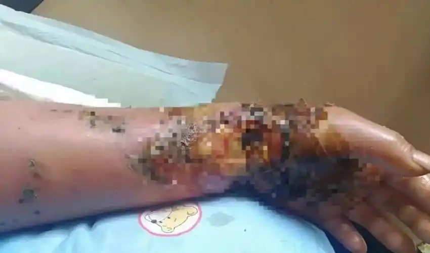 五步蛇浙江女子上山挖笋被毒蛇咬结果连骨头都溃烂了