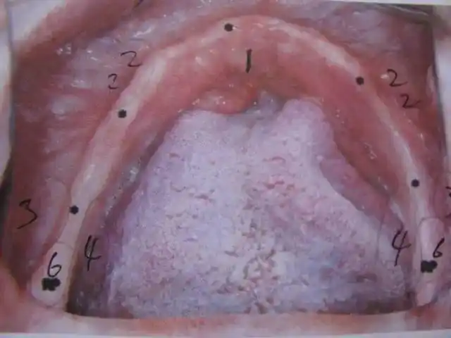 2颊系带 3颊棚区 咬肌切迹 4舌骨后窝 6磨牙后垫再整体的看看无牙下颌