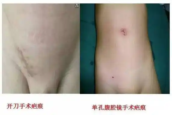 精益求精小儿腹股沟斜疝和鞘膜积液的单孔腹腔镜手术