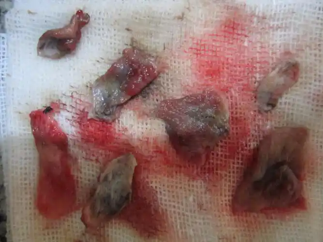 肛乳头瘤王先生前术中术后图片集