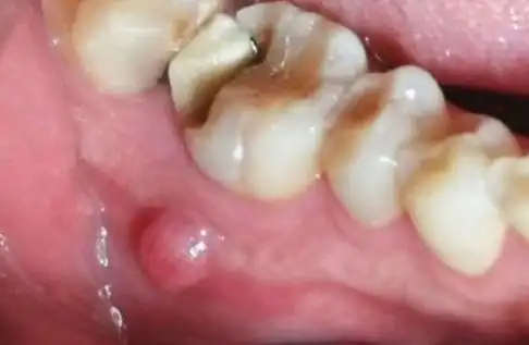 但感染范围也会越来越大,而进一步发展会形成根尖囊肿,根尖肉芽肿等