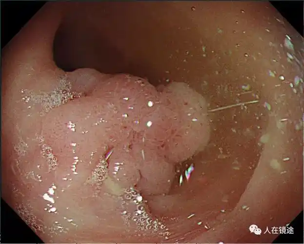 警惕无症状结肠腺瘤癌变