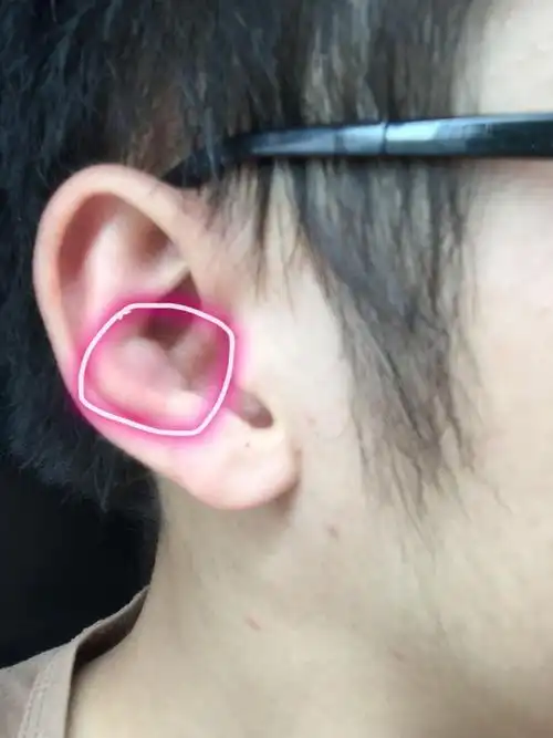 耳朵内测长了个肿泡是怎么回事,需要去看医生吗?求助!好人一世平安!