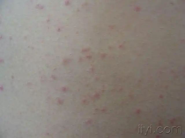 周身斑丘疹 - 皮肤及性传播疾病讨论版 - 爱爱医医学论坛