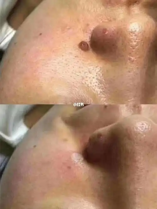 无痛祛痣点疣技术培训,全国招商合作_祛痣_脂肪粒_扁平疣_痣祛痣疣_美