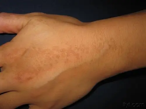 看图识病线状或螺旋状痣样黑素沉着病