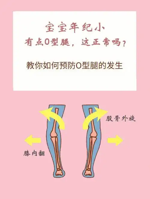 0型腿正常吗最近有在后台收到个别麻麻的咨询小孩一岁多了,有点o型腿