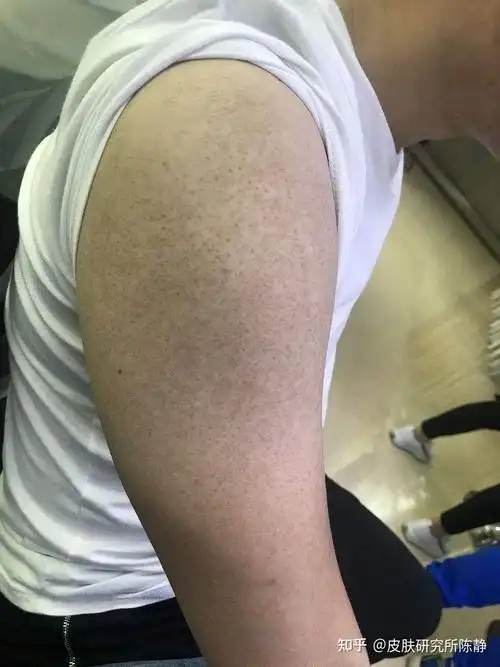 什么是毛周角化症什么是鸡皮肤