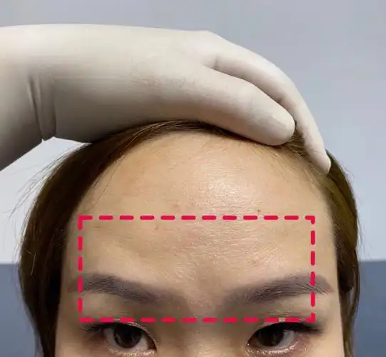 印堂77眉弓骨凹陷衔接细胞激活