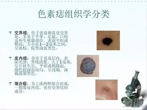 交界痣与混合痣因有交界活力,就可能会恶性变,皮内痣无交界活力,一般