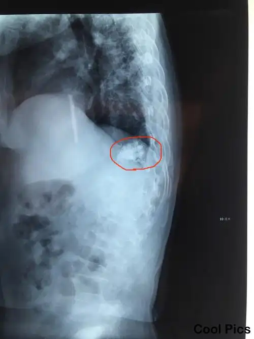 李,女,68岁.胸椎骨质疏松性骨折经皮穿刺椎体成形术(pkp)病例